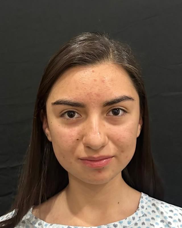 Antes: Comparativo clínico frontal de rinoplastia