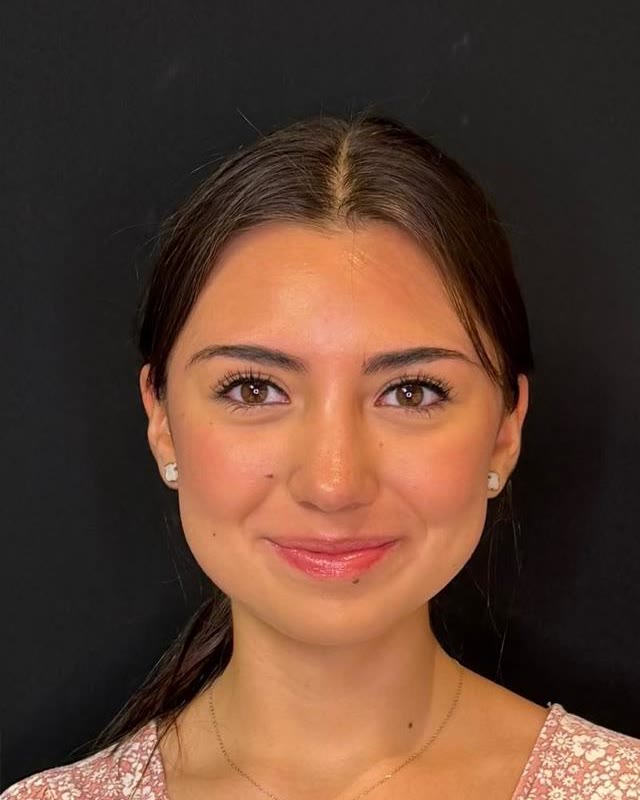 Después: Comparativo clínico frontal de rinoplastia